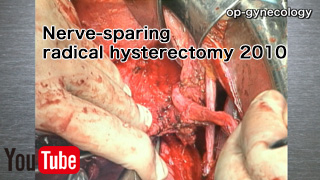 自律神経温存広汎子宮全摘術（Nerve-sparing radical hysterectomy 2010）